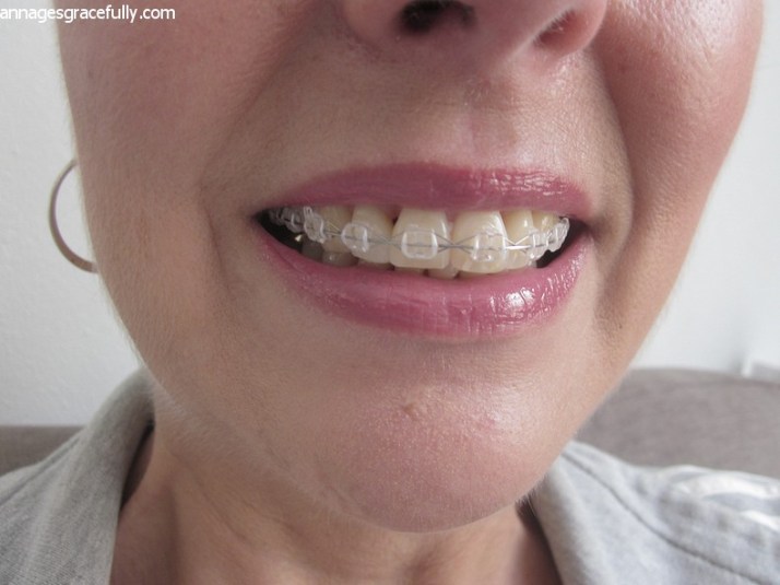 beugelbekkie Ann Ages Gracefully